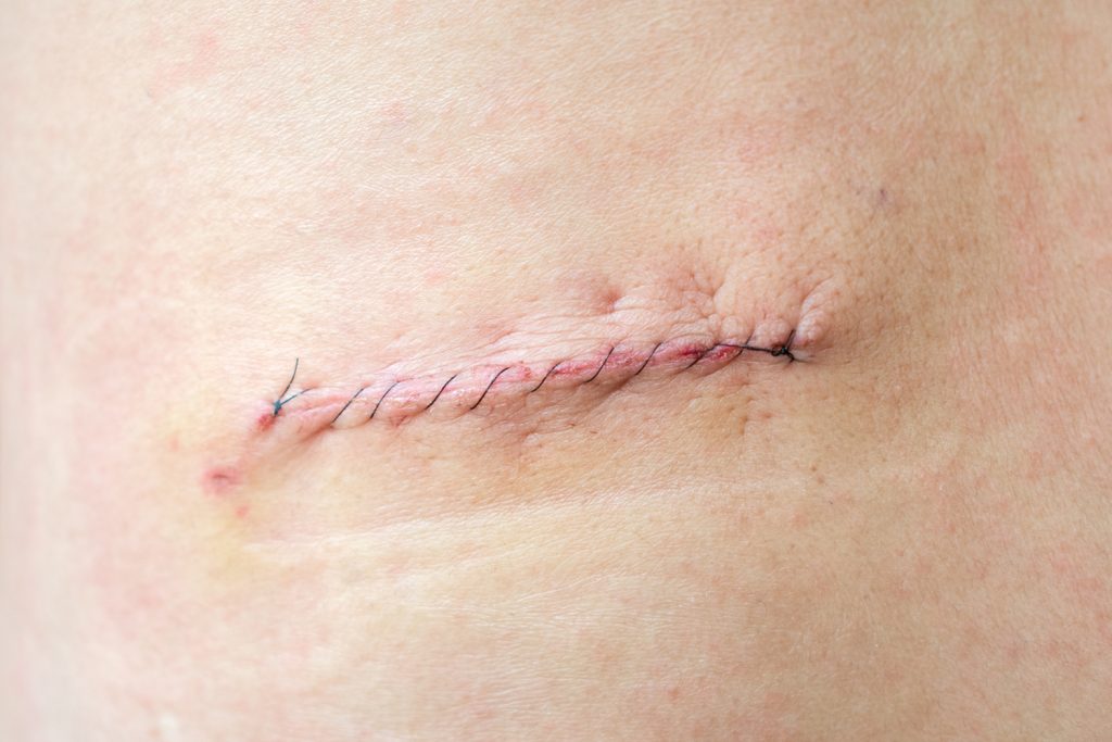 Szkolenie terapii blizn Szczecin jako istotny element nowoczesnej działalności z osobą leczoną