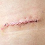 Szkolenie terapii blizn Szczecin jako istotny element nowoczesnej działalności z osobą leczoną